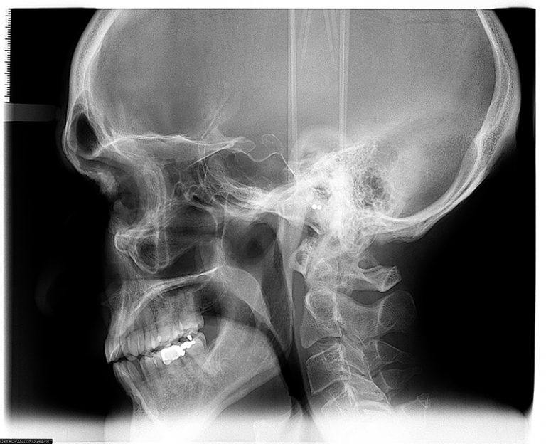 Cephalometric X-Ray - Louisville Dental Associates